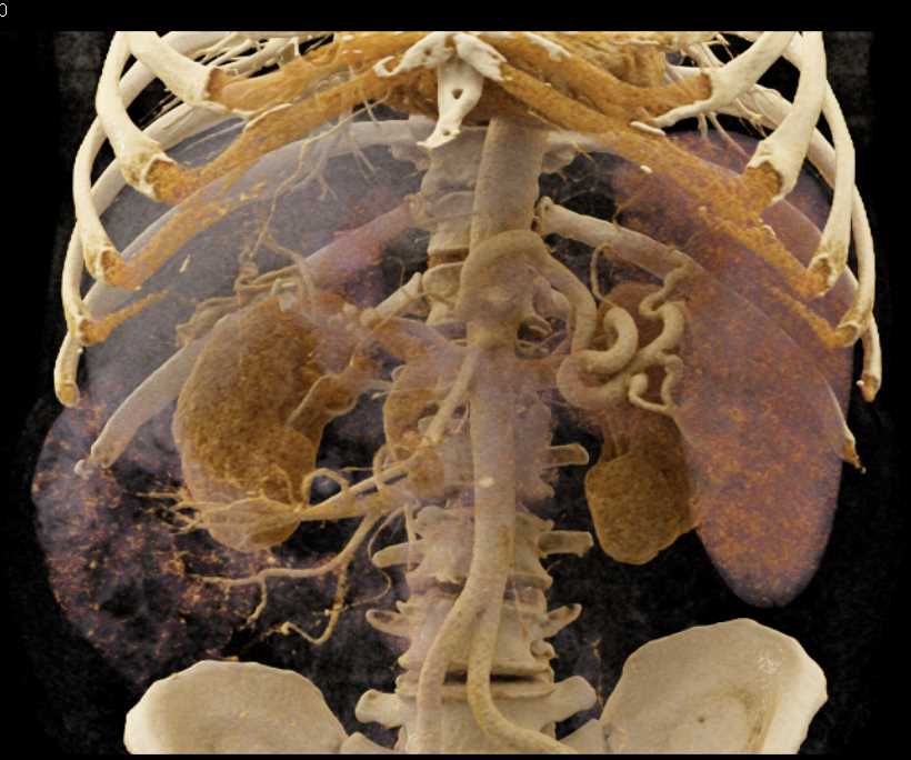 Cirrhosis with Extensive Collaterals in the Abdominal Wall - CTisus CT Scan