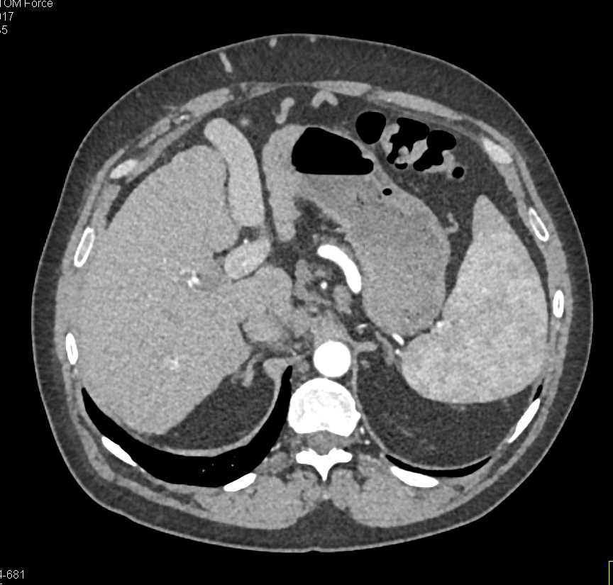 Cirrhosis with Extensive Collaterals in the Abdominal Wall - Liver Case ...