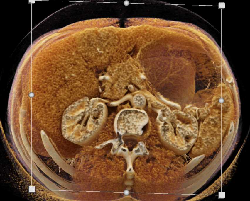 Focal Nodular Hyperplasia (FNH) Liver - CTisus CT Scan