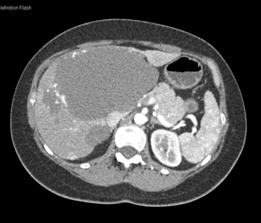 Hepatic Hemangioma - CTisus CT Scan