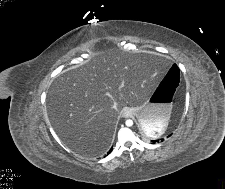 Fatty Infiltration of the Liver - CTisus CT Scan