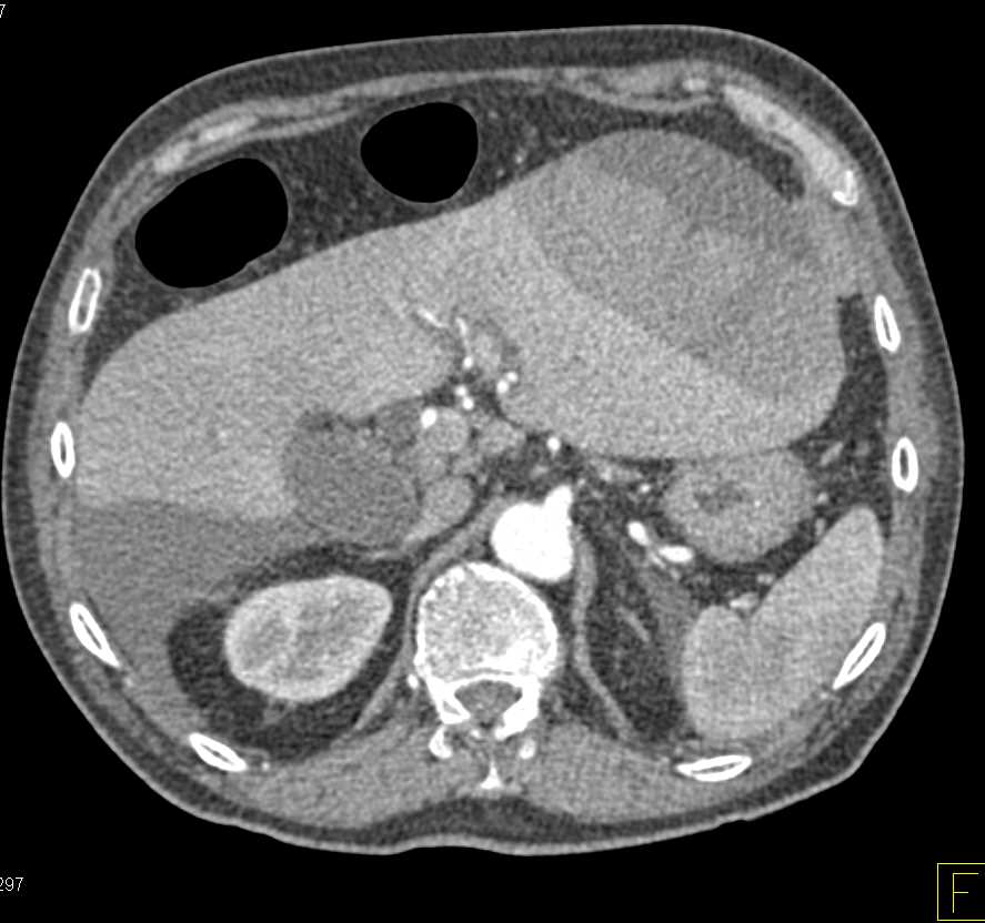 Bleed Left Lobe of the Liver - CTisus CT Scan