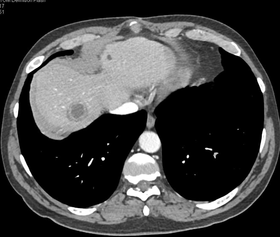 Liver Abscess Simulates Metastases - CTisus CT Scan