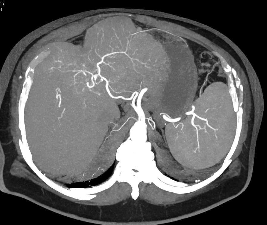 Hepatocellular Carcinoma (Hepatoma) with Portal Vein Involvement - CTisus CT Scan