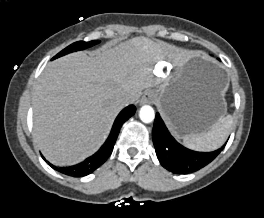 Focal Nodular Hyperplasia (FNH) Left Lobe of the Liver - CTisus CT Scan