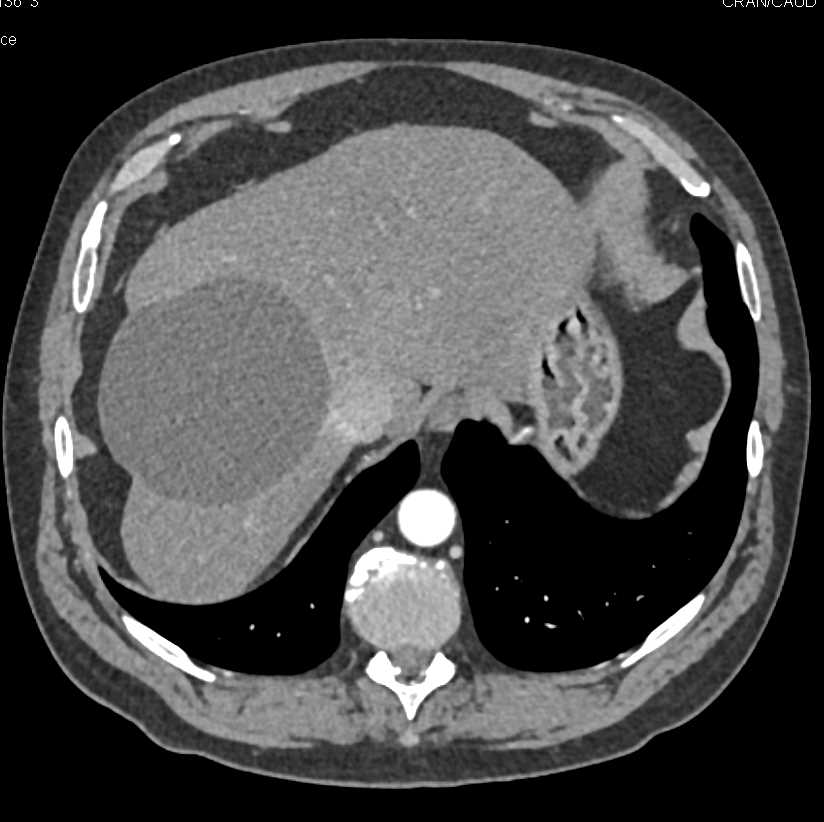 Hepatic Cysts and Hemangiomas - CTisus CT Scan