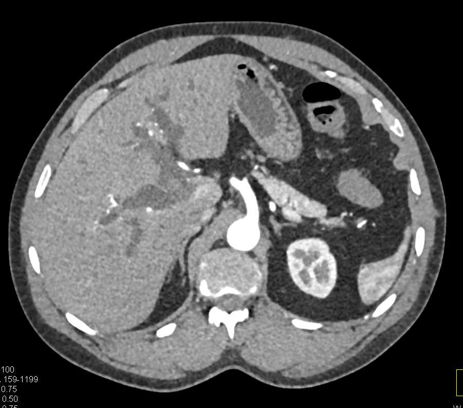 Gallbladder Cancer Invades into the Common Bile Duct - CTisus CT Scan