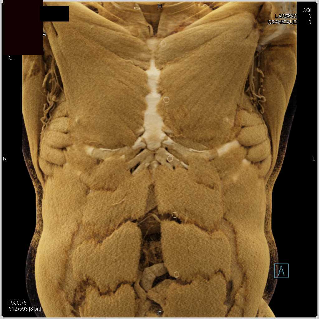 Invasive Gallbladder Cancer Extends into the Liver - CTisus CT Scan