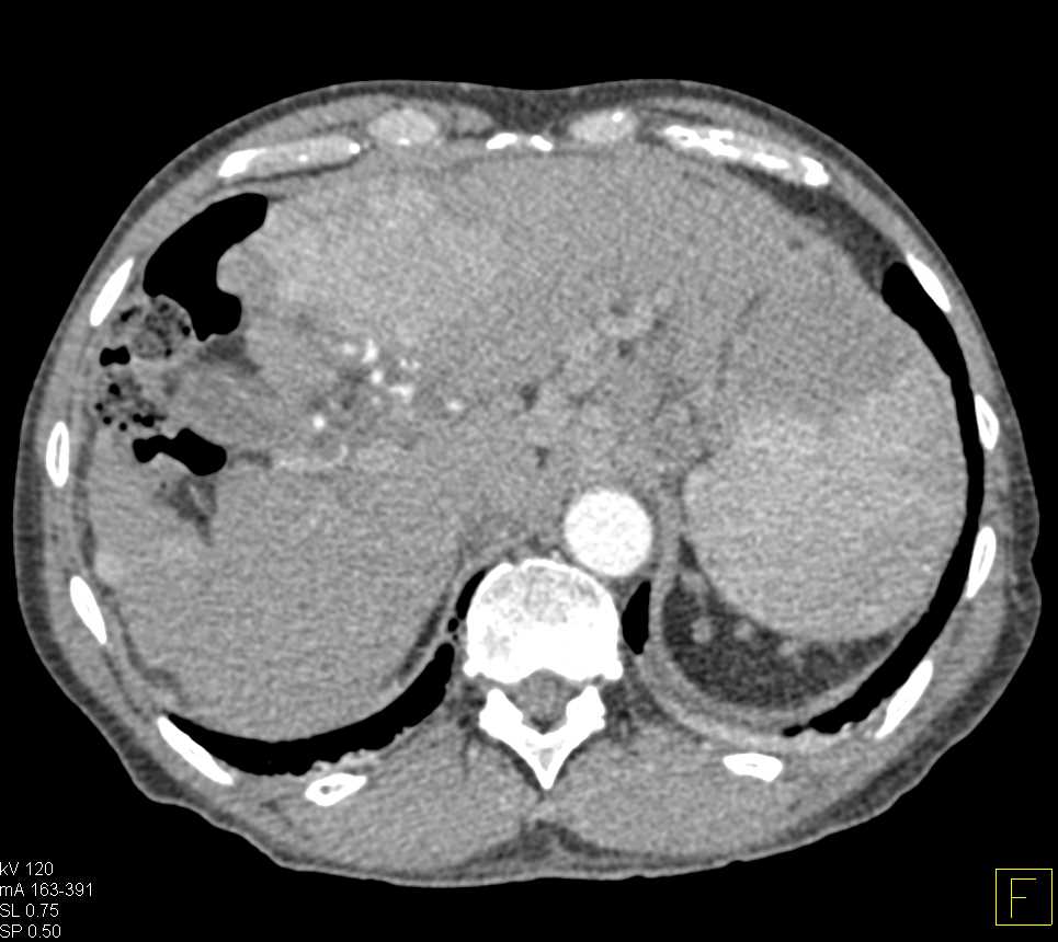 Liver Abscess - CTisus CT Scan