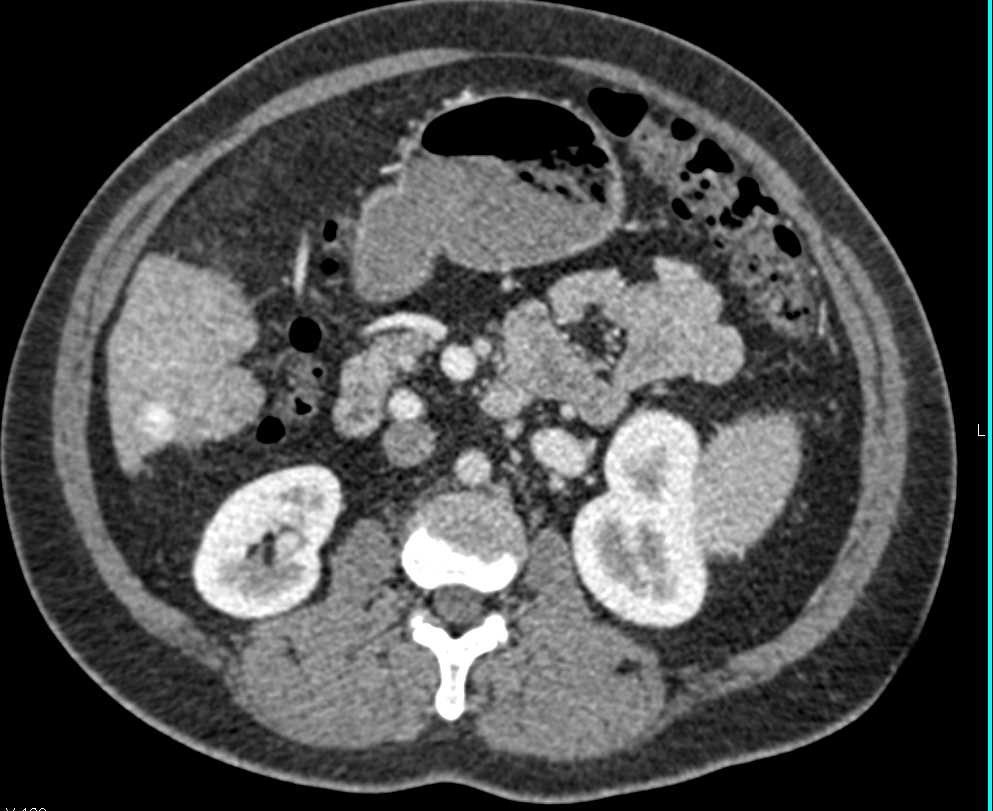 Regenerating Nodule in a Cirrhotic Liver - CTisus CT Scan