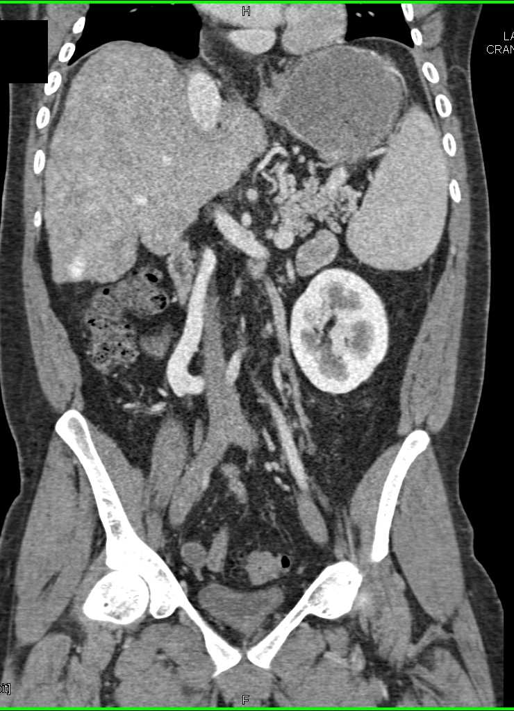 Regenerating Nodule in a Cirrhotic Liver - CTisus CT Scan