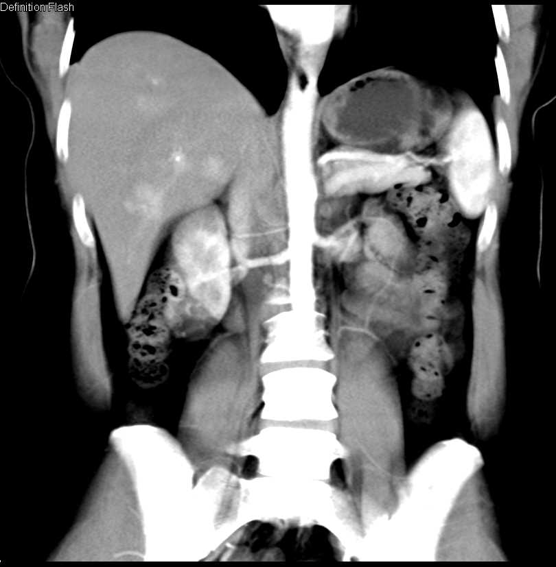 Hepatic Hemangiomas - CTisus CT Scan
