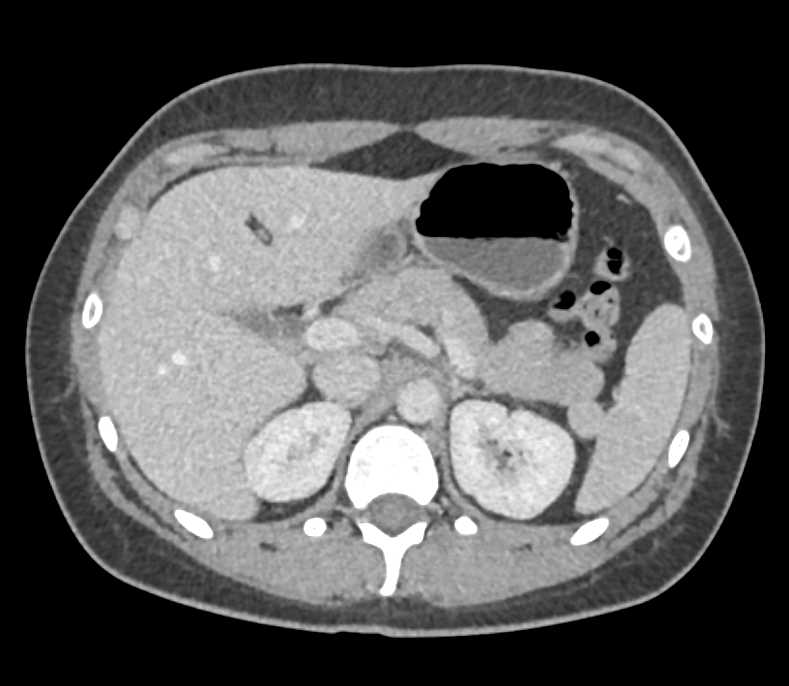 Hepatic Hemangiomas - CTisus CT Scan