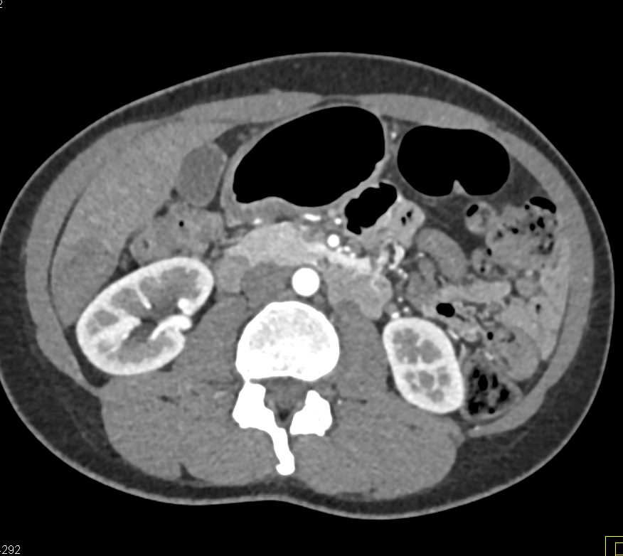 Multiple Focal Nodular Hyperplasias (FNHs) in the Liver - CTisus CT Scan