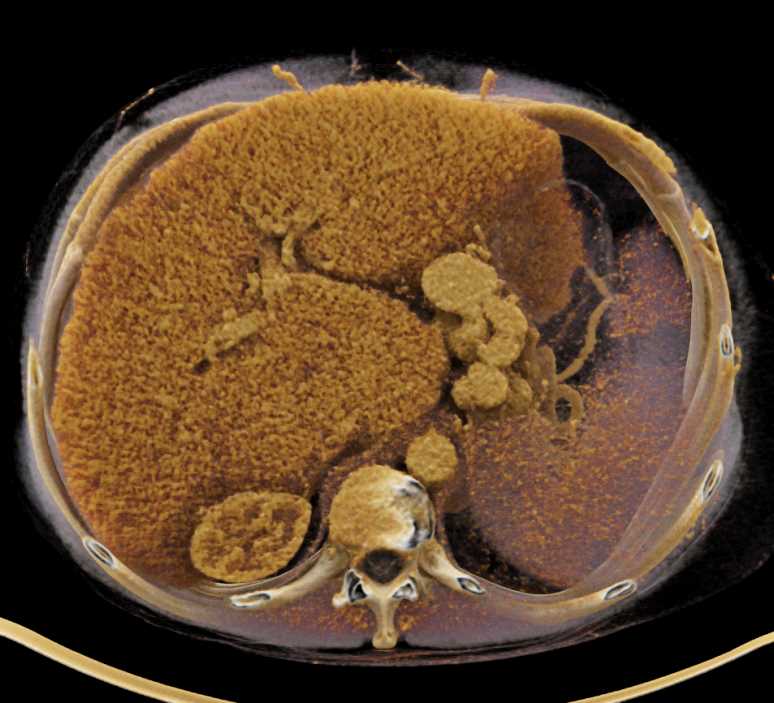 Cirrhosis with Portal Hypertension - CTisus CT Scan