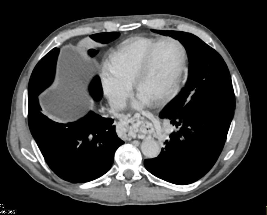 Cirrhosis with Varices and Portal Hypertension - CTisus CT Scan