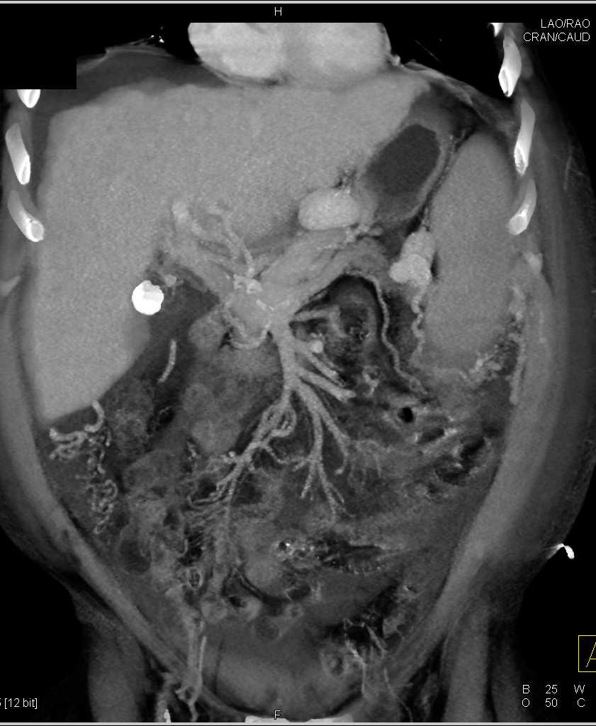Cirrhosis with Varices and Portal Hypertension - CTisus CT Scan