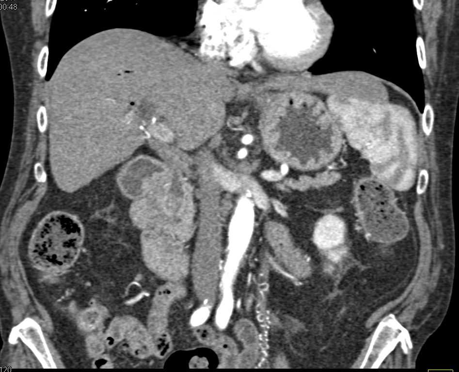 Impacted Stones in the Distal Common Bile Duct - CTisus CT Scan