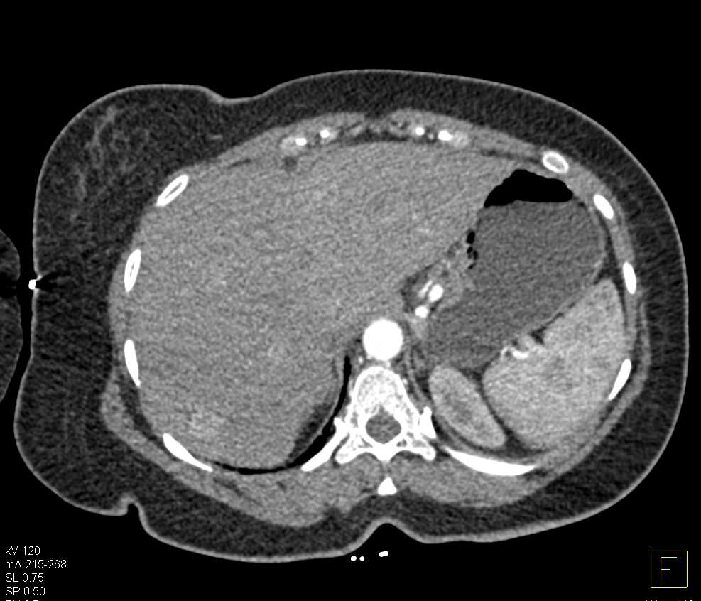 Multiple Liver Metastases - CTisus CT Scan