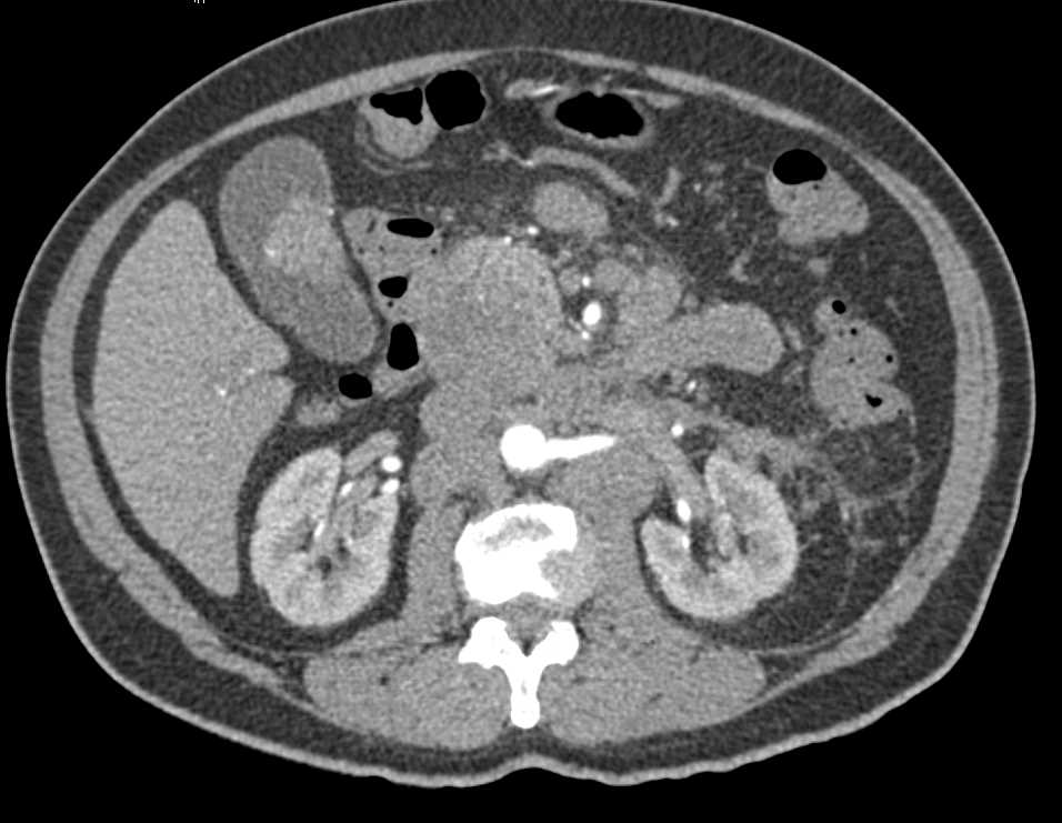 Melanoma with Extensive Nodes and Mets to the Gallbladder - CTisus CT Scan