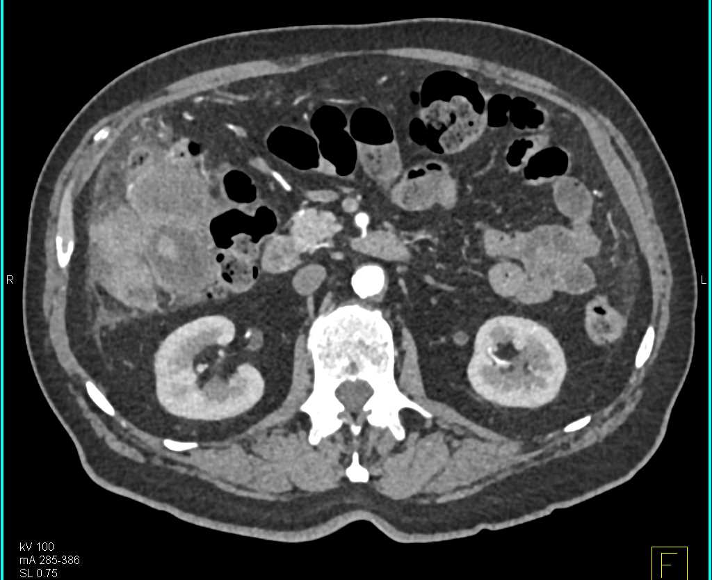 Gallbladder Cancer Invades the Liver - CTisus CT Scan