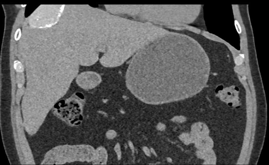 High Density Hepatic Cyst - CTisus CT Scan