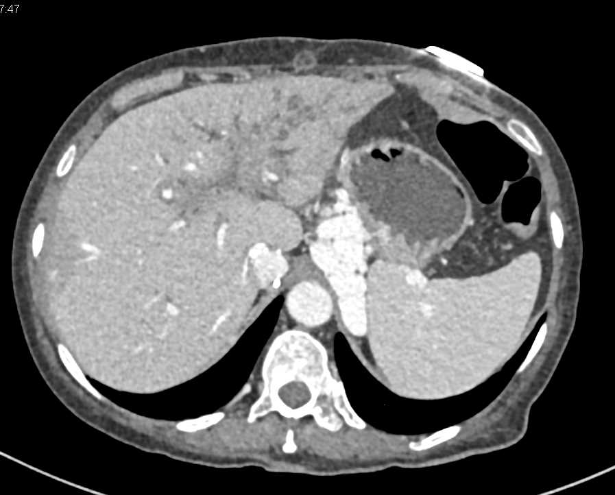 Cholangiocarcinoma with Huge Varices - CTisus CT Scan