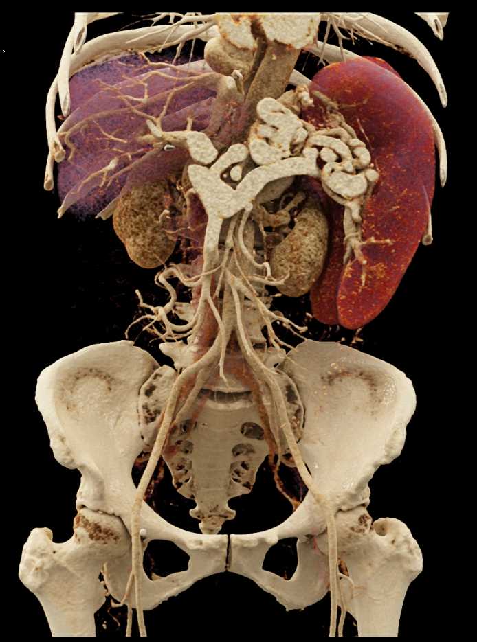 Portal Hypertension with Large Varices - CTisus CT Scan