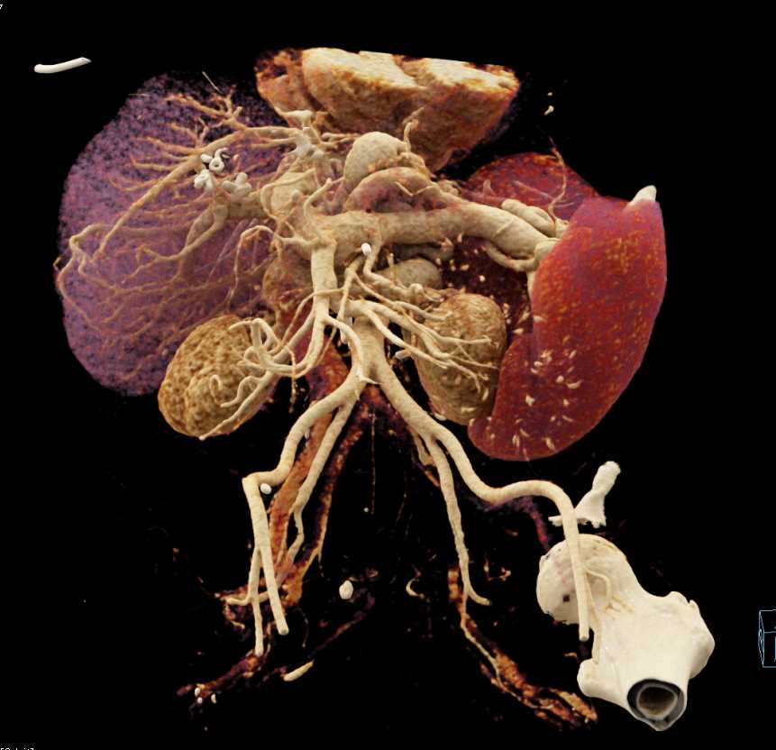 Portal Hypertension with Large Varices - CTisus CT Scan
