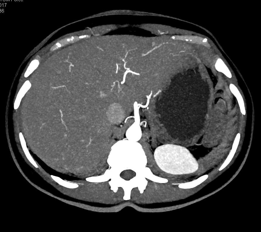 Vascular Liver Metastases - CTisus CT Scan