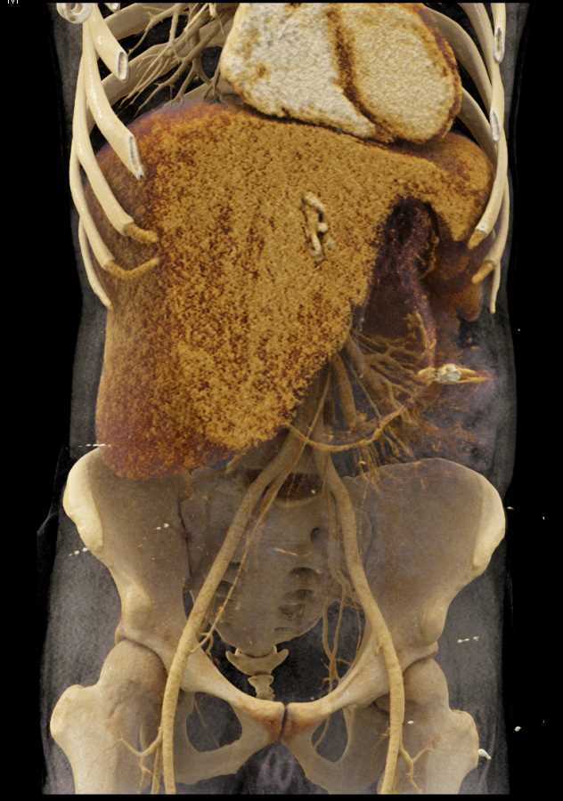 Texture Mapping of the Liver - CTisus CT Scan