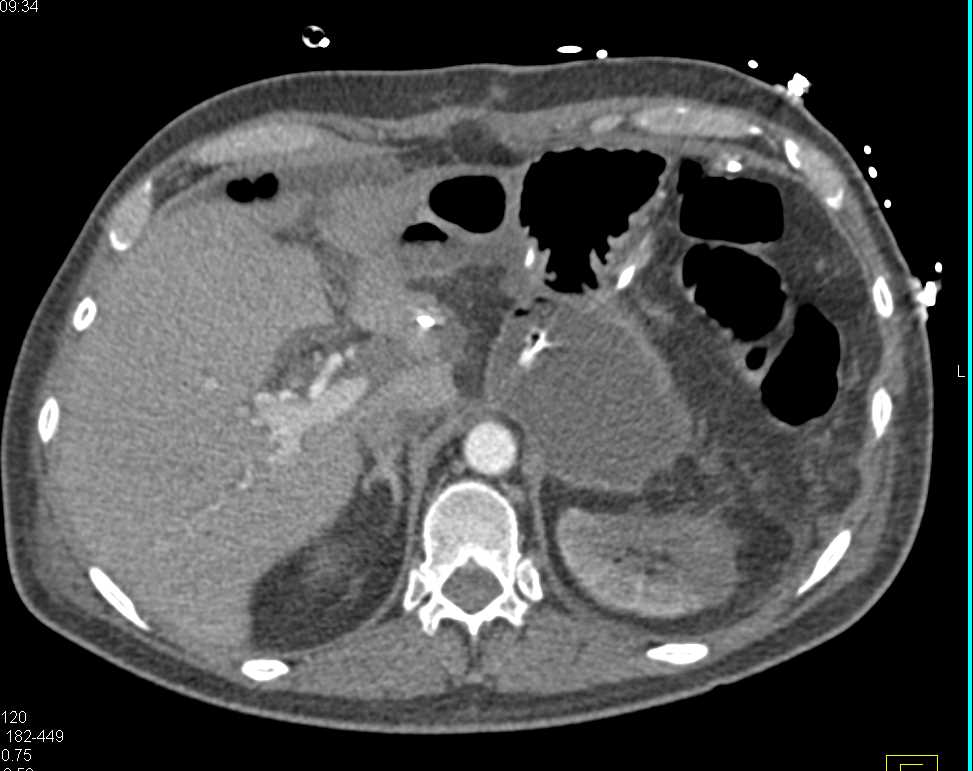 Graft from Iliac Artery to Hepatic Artery Post Liver Transplant - CTisus CT Scan