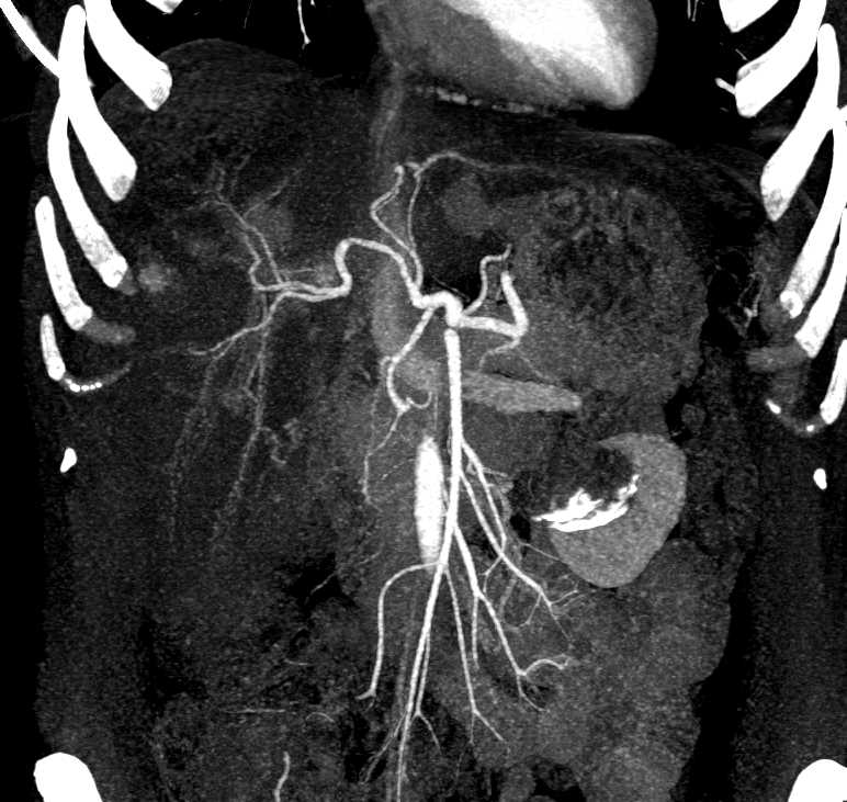 Focal Nodular Hyperplasia - CTisus CT Scan