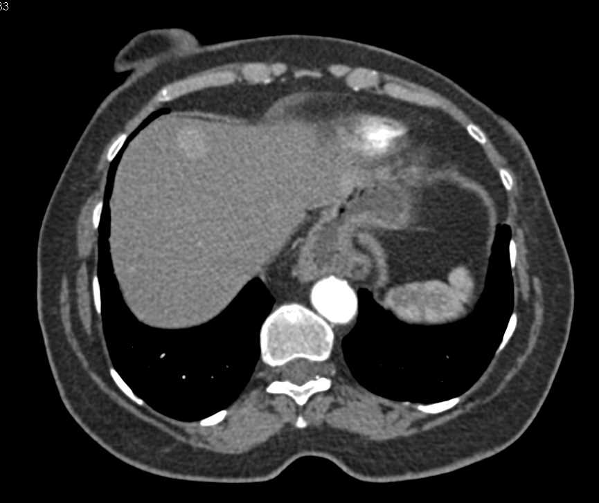 Vascular Metastases to the Liver Become Isodense - CTisus CT Scan