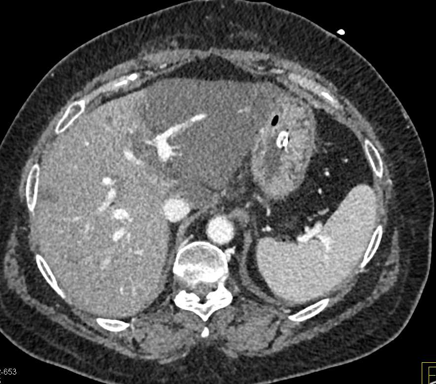 Focal fatty Infiltration of the Liver - Liver Case Studies - CTisus CT