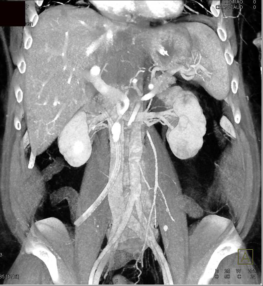 Focal fatty Infiltration of the Liver - Liver Case Studies - CTisus CT