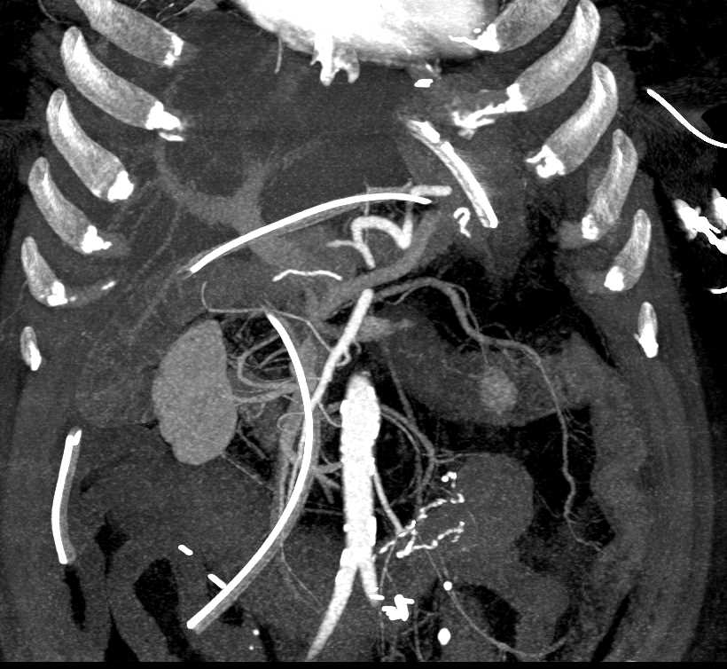 Focal fatty Infiltration of the Liver - CTisus CT Scan