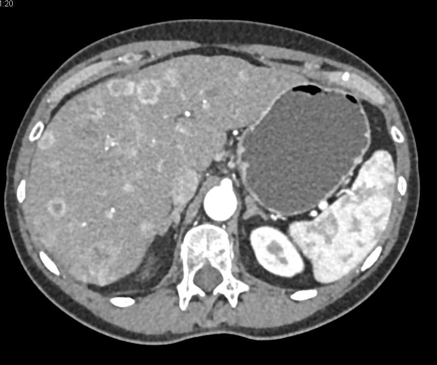 Metastatic Neuroendocrine Tumor to the Liver - CTisus CT Scan