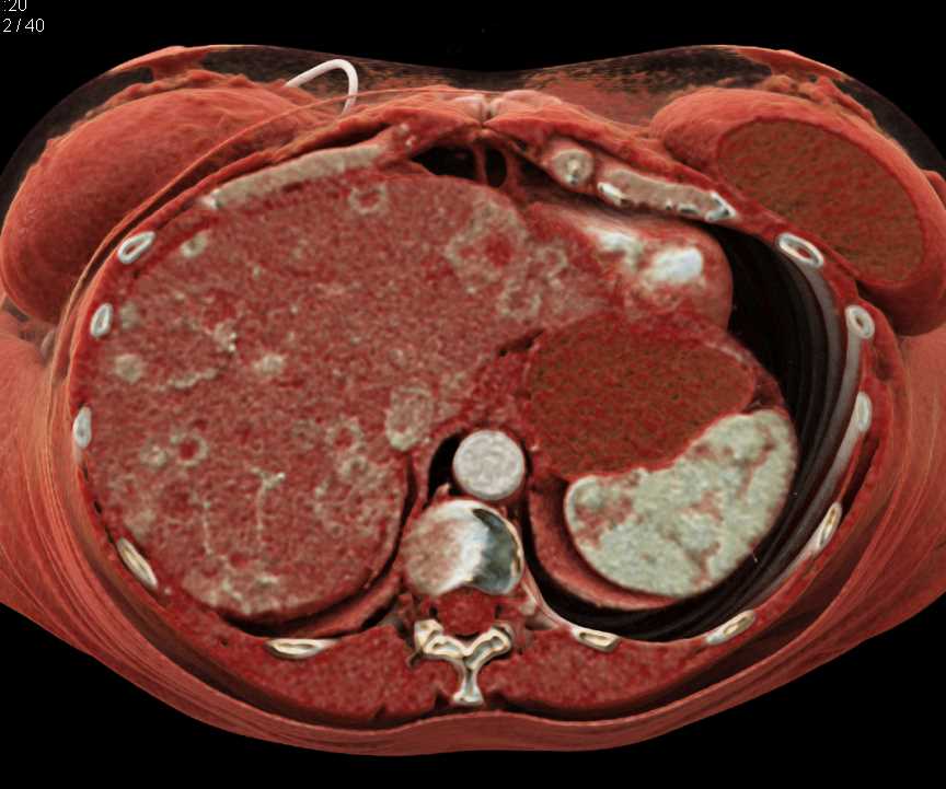 Metastatic Neuroendocrine Tumor to the Liver with Cinematic Rendering - CTisus CT Scan