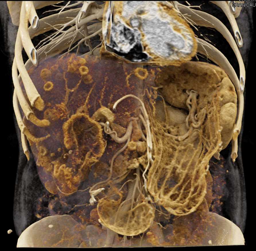 Metastatic Neuroendocrine Tumor to the Liver with Cinematic Rendering - CTisus CT Scan