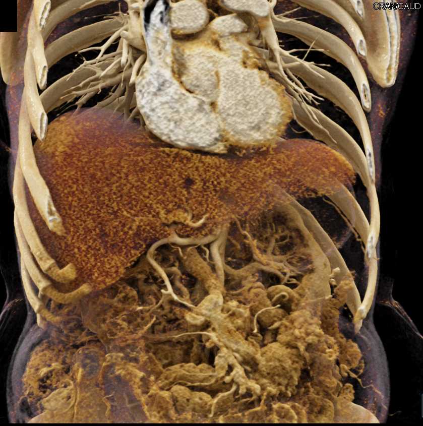 Patchy Liver Enhancement - CTisus CT Scan