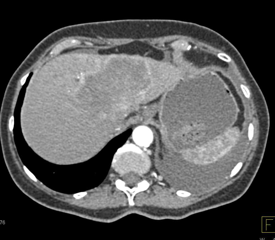 Hepatocellular Carcinoma (Hepatoma) - CTisus CT Scan