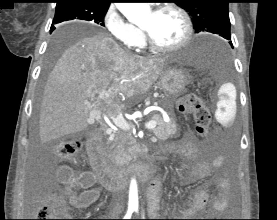 Cholangiocarcinoma Invades the Portal Vein - CTisus CT Scan