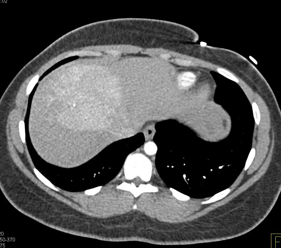 Unusual Appearance of Focal Nodular Hyperplasia (FNH) - CTisus CT Scan