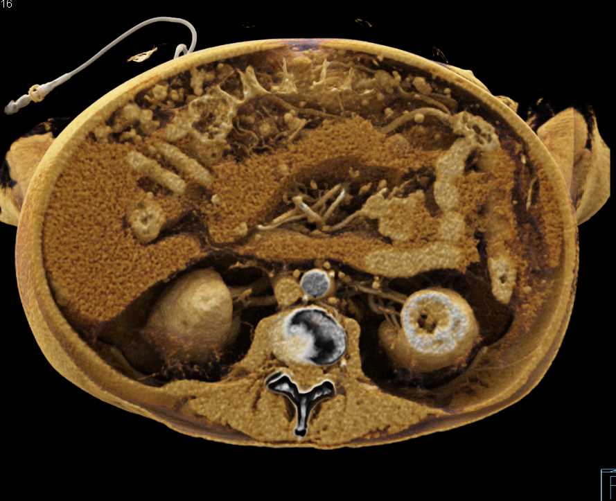 Carcinoma Tail of Pancreas with Carcinomatosis - CTisus CT Scan