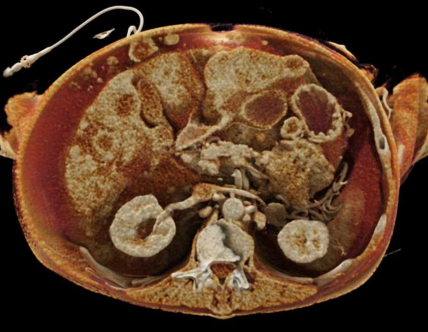 Carcinoma Tail of Pancreas with Carcinomatosis - CTisus CT Scan