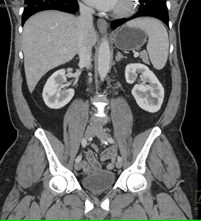 Hepatic Hemangioma - CTisus CT Scan