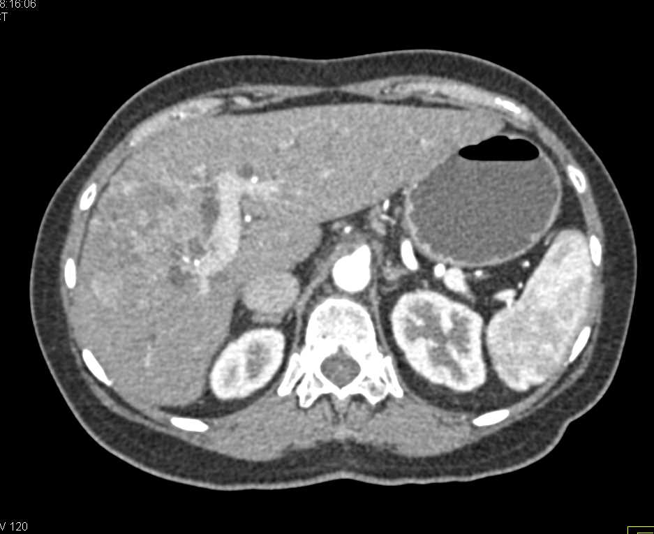 Hepatocellular Carcinoma (Hepatoma) with Neovascularity - CTisus CT Scan