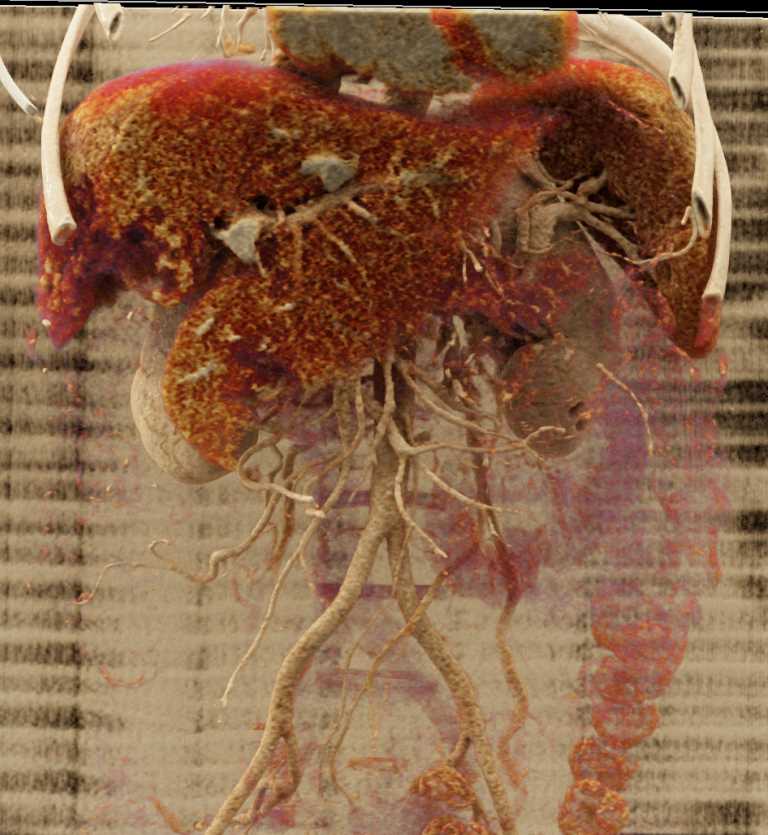 Hepatocellular Carcinoma (Hepatoma) with Neovascularity with Cinematic Rendering - CTisus CT Scan