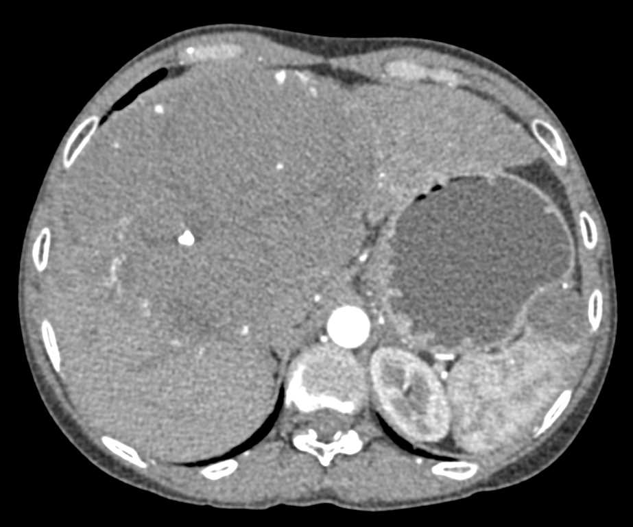 Giant Cavernous hemangioma of the Liver - CTisus CT Scan